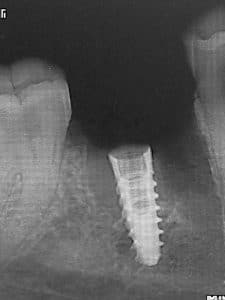 Stabilization of the implant in 3 mm of bone, in an apical position close to the nerve.