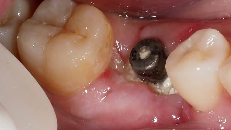 Healing assessment and removal of the stitches after 12 days