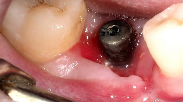 Healing assessment after 20 days