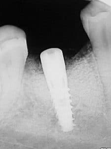 Bone level is maintained. 2 months post-op