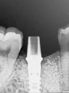 Bone level is maintained. 4 months post-op