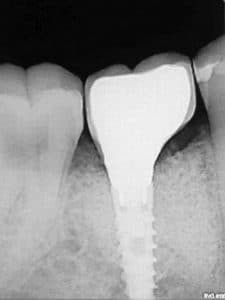 Prosthesis delivery. Bone level is stable and the implant is well osseointegrated. 8 months