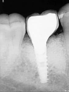 Prosthesis delivery. Bone level is stable and the implant is well osseointegrated. 4 years.