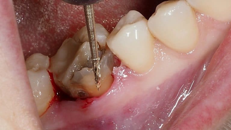 Complex extraction of the molar in 46.