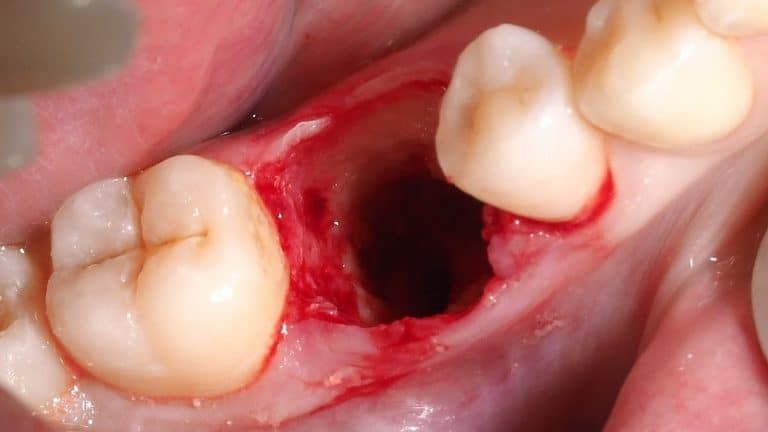The extraction leaves a bone defect of the whole alveolus area.