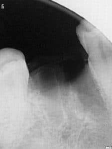 The extraction leaves a bone defect of the whole alveolus area.