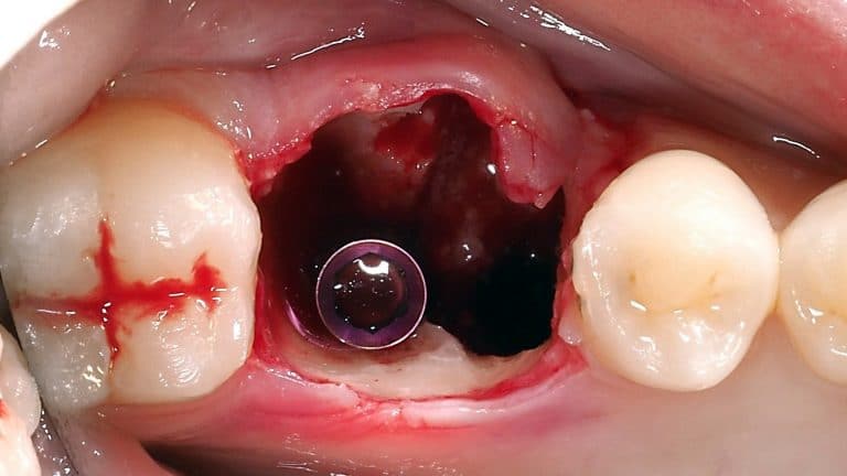 Stabilization of the implant in 3mm of bone in an apical position close to the nerve.