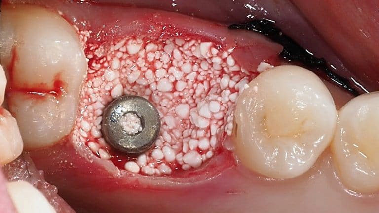 Filling of the defect with MimetikOss S.