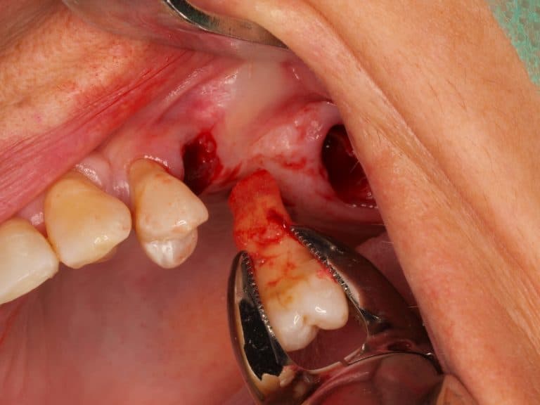 photo of removal of tooth