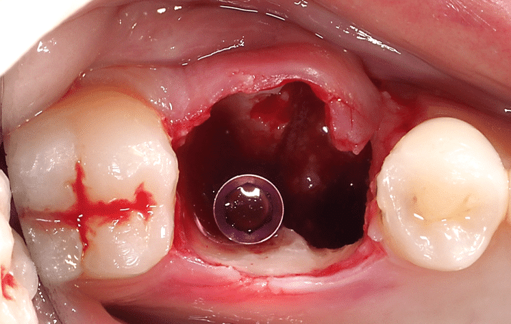 Stabilization of the implant in only 3mm of bone, in an apical position almost in contact with the dental nerve.