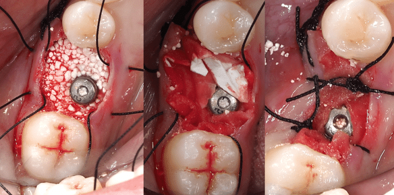 Membrane placement and suture.