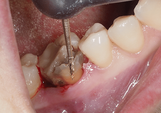 Surgery Day. Complex extraction of the molar in position 46.